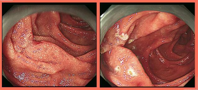 潍医附院三联疗法,十二指肠内窥镜双镜联合手术费用