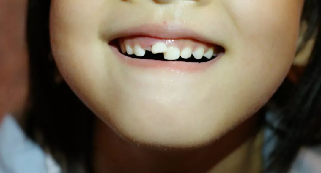 牙长歪了怎么办可以矫正吗,一岁多小孩牙长歪了怎么办