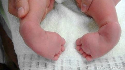 宝宝脚内翻因为什么,刚出生的婴儿脚内翻如何治疗