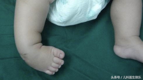 宝宝脚内翻因为什么,刚出生的婴儿脚内翻如何治疗