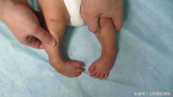宝宝脚内翻因为什么,刚出生的婴儿脚内翻如何治疗