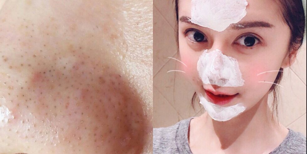 粉刺夹出来后怎么收缩毛孔,挑粉刺前怎么扩大毛孔