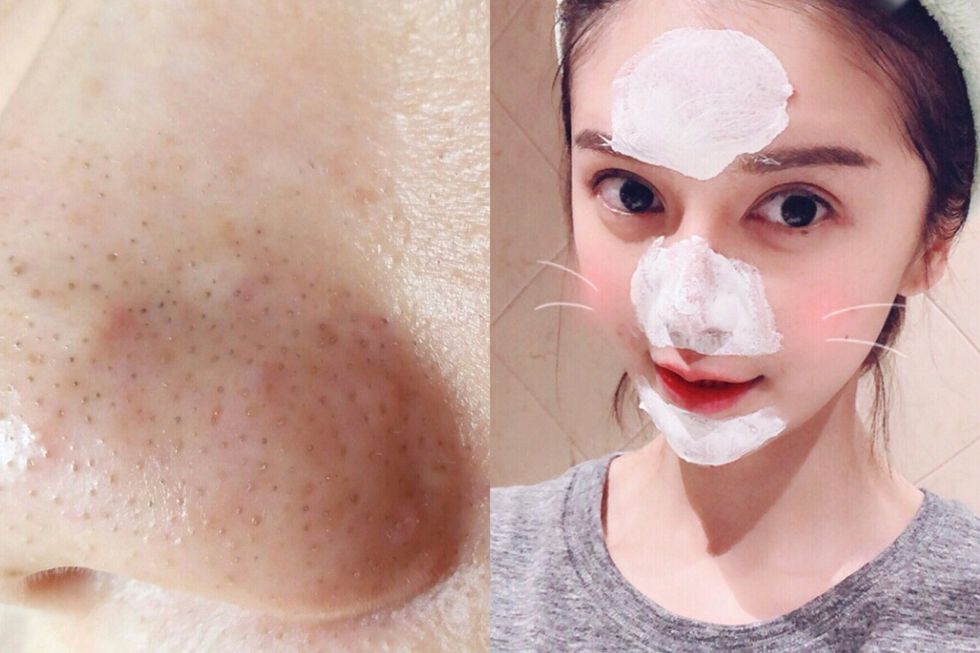 粉刺夹出来后怎么收缩毛孔,挑粉刺前怎么扩大毛孔