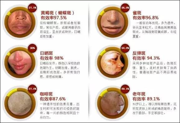 如何判断斑类型,看图识斑看看你究竟是什么斑