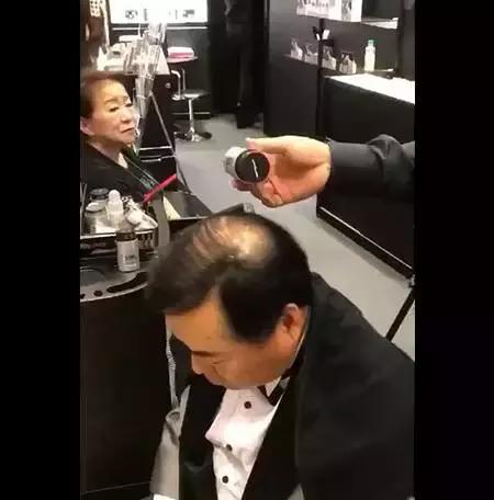 脱发比较严重的90后,脱发严重发际线越来越高