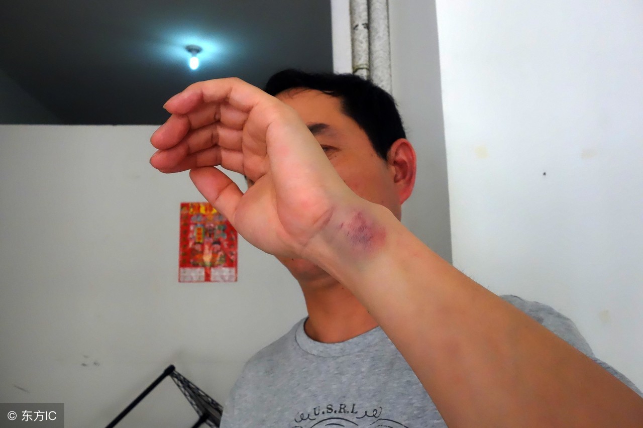 身上莫名其妙淤青是怎么回事,身上为什么会莫名其妙出现淤青