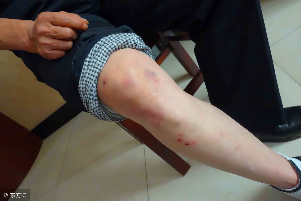 身上莫名其妙淤青是怎么回事,身上为什么会莫名其妙出现淤青