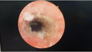 调理子宫内膜的中医疗法,女性内膜修补术过程