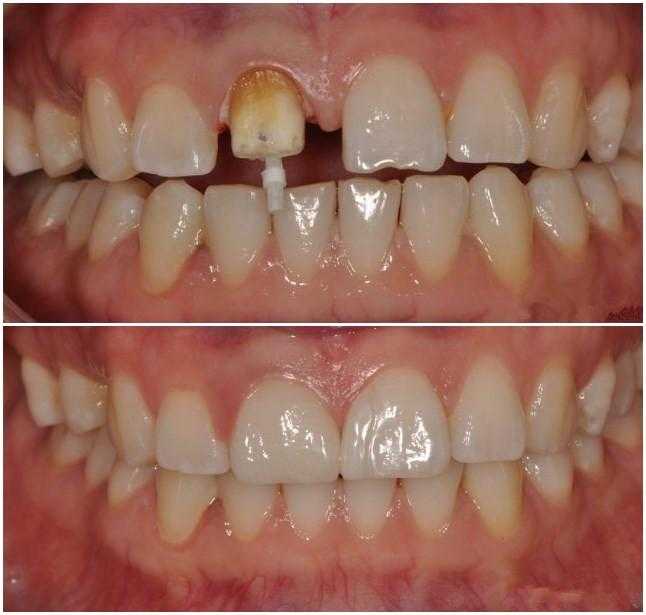 种植牙比假牙好吗,种牙与镶牙费用对比