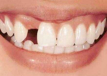 种植牙比假牙好吗,种牙与镶牙费用对比