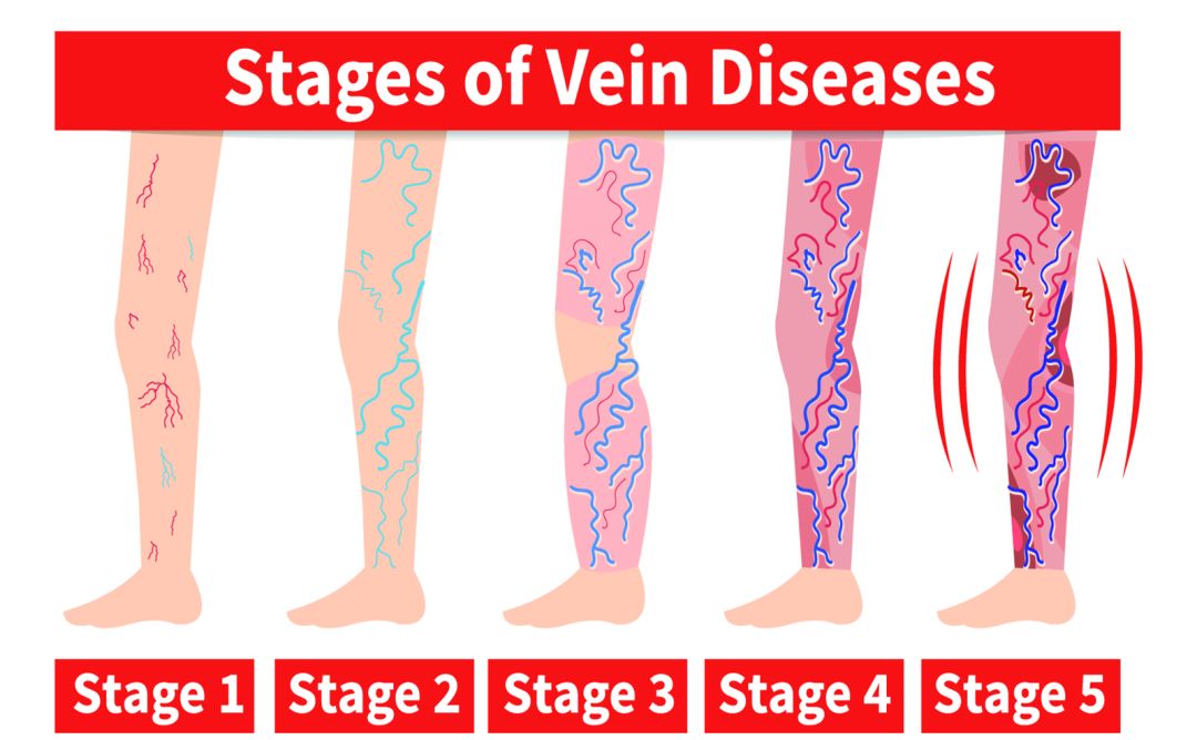 跷二郎腿有什么危害腿粗,跷二郎腿有什么危害图片