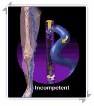 跷二郎腿有什么危害腿粗,跷二郎腿有什么危害图片