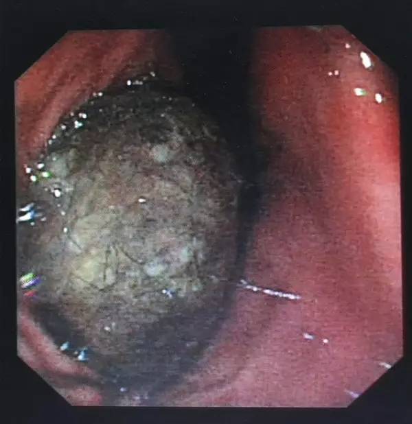 小孩吃了一根头发到肚子里怎么办,小孩吃了一根头发进肚子里