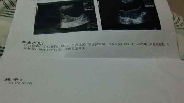 B超不见胎心胎芽，并不一定是胚胎停育！