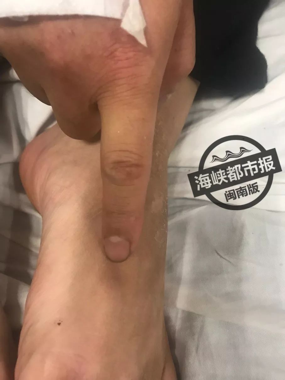 蚂蚁被咬后抢救,男子被蚂蚁咬伤未及时就医