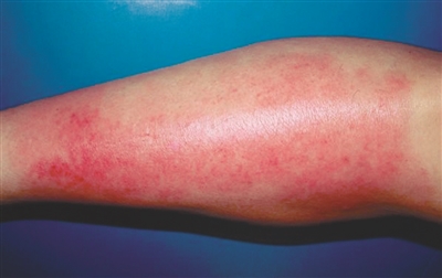 下雨天穿拖鞋会被传染病毒吗,下雨光脚趟水的危害