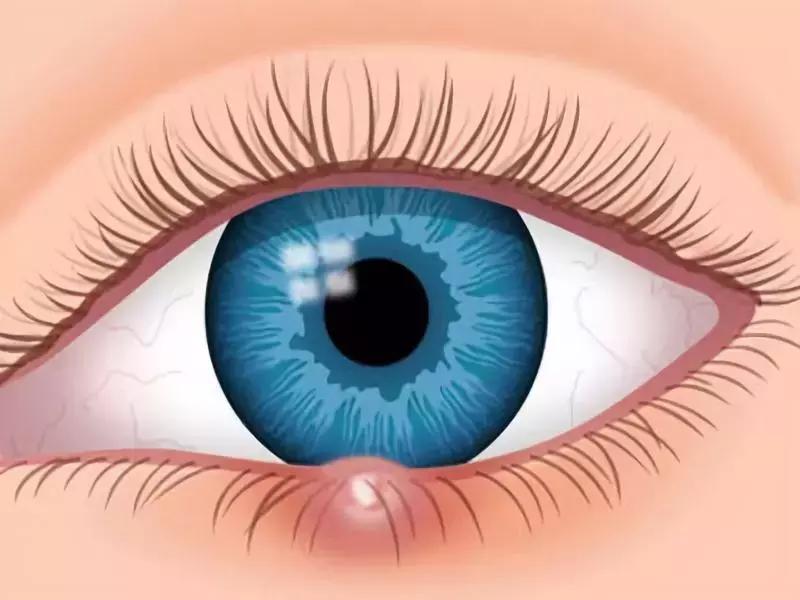 眼肿麦粒肿可以使用什么药物,眼睛起麦粒肿怎么办小妙招