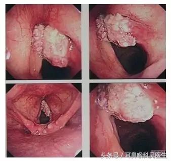 嗓子哑了怎么办小学生,嗓子哑了怎么办女生