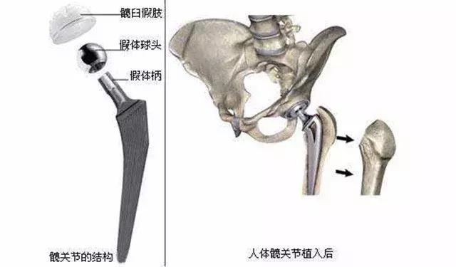 股骨头坏死早期症状是怎样的,早期股骨头坏死需要24小时拄拐吗