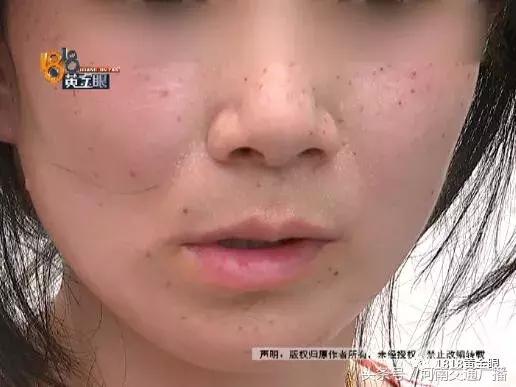 去医院取痣花了1000多元,女孩点痣8000元