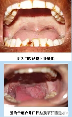 年轻人一定要远离槟榔,槟榔爱好者远离槟榔珍爱生命