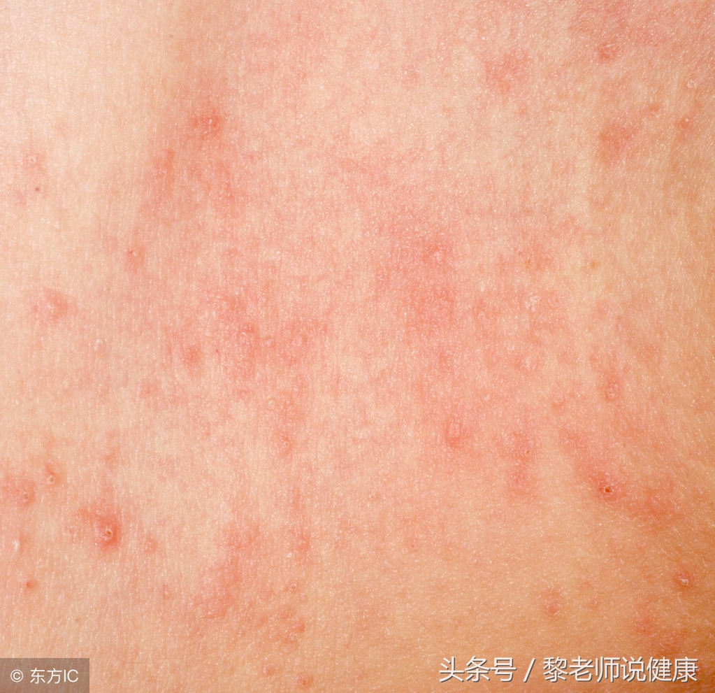 湿疹奇痒难忍打什么针好,湿疹瘙痒吃点什么食疗