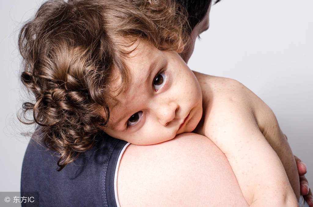 麻疹宝宝,婴儿荨麻疹反反复复怎么办呀