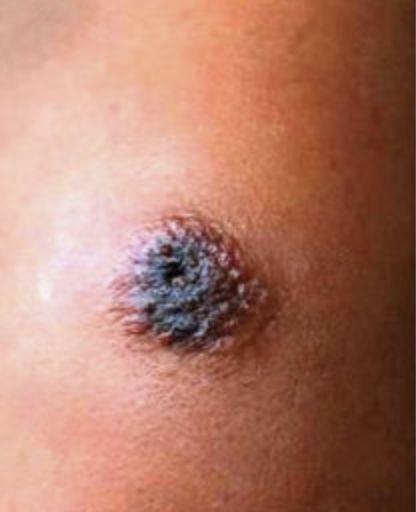 炭疽病最新疫情辽宁,辽宁海城牛庄牛炭疽疫情最新进展