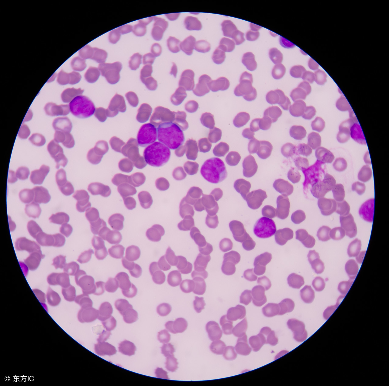 淋巴瘤检查什么最准确,petct检查淋巴瘤