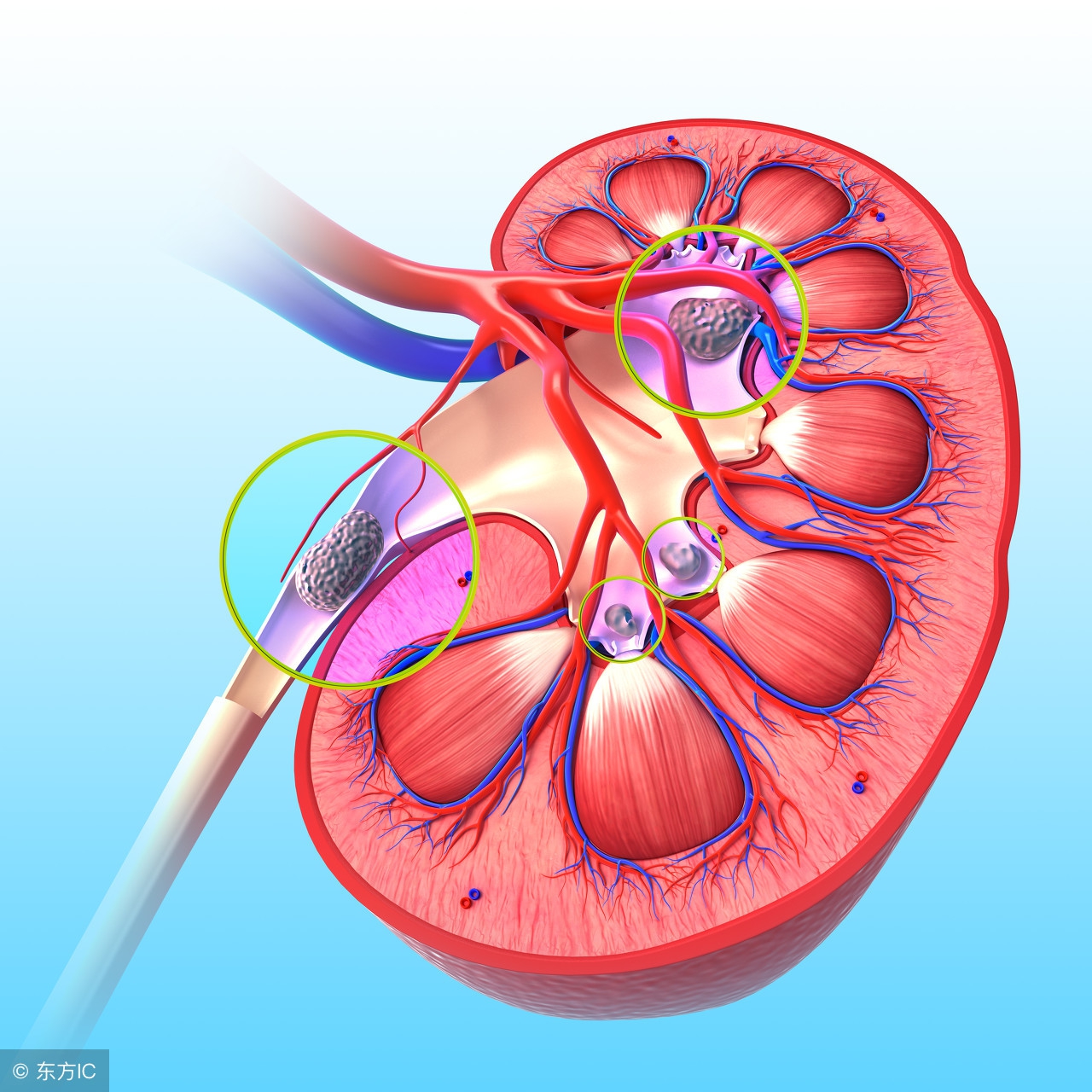 肾结石体外碎石都有哪些技术,做了体外碎石怎么没看见石头排出