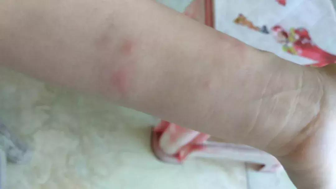 麻疹和荨麻疹的区别在哪,得了麻疹该怎么治疗