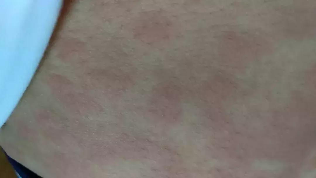 麻疹和荨麻疹的区别在哪,得了麻疹该怎么治疗