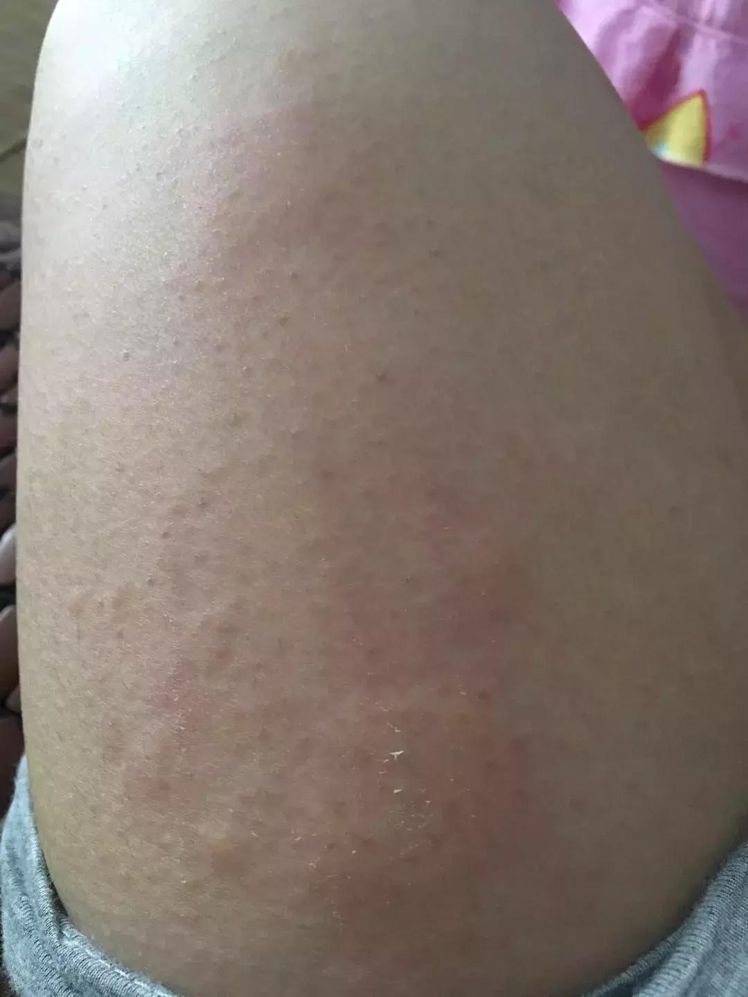 麻疹和荨麻疹的区别在哪,得了麻疹该怎么治疗