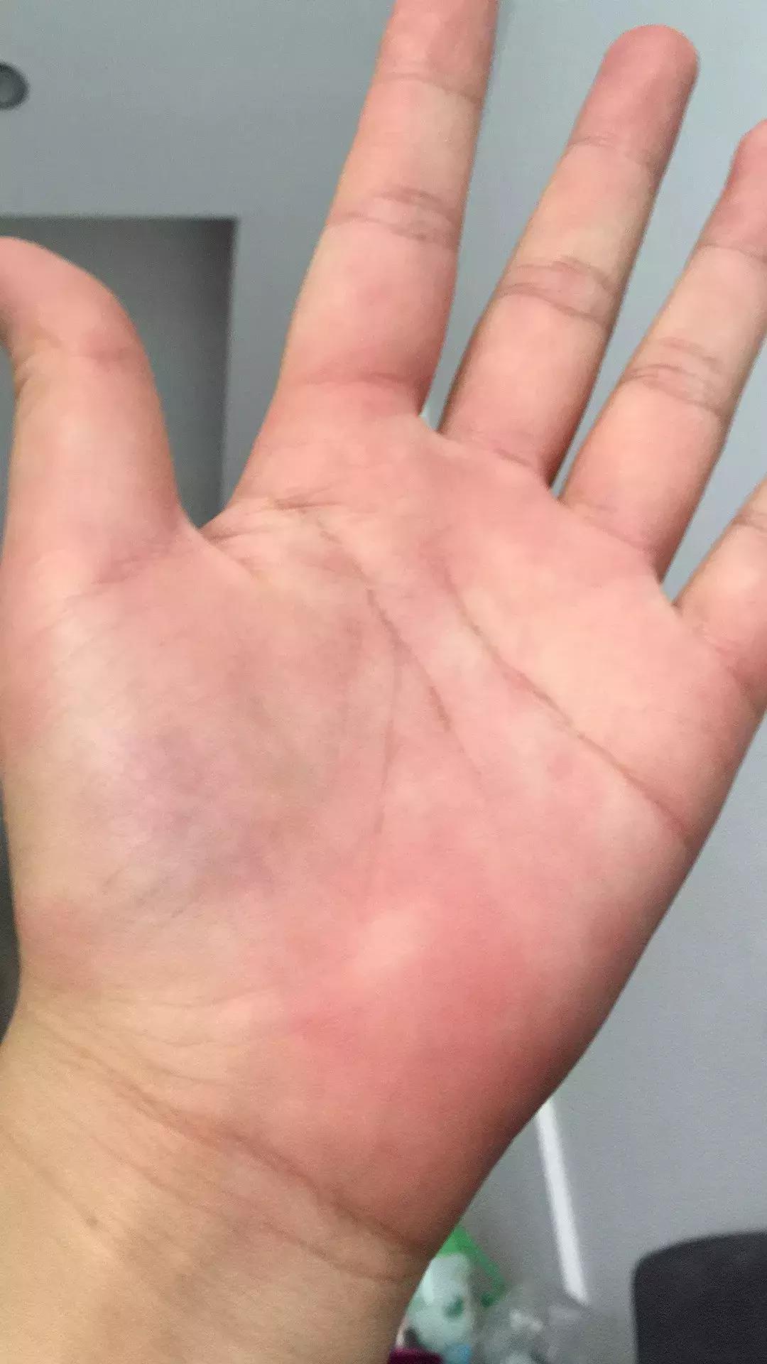 麻疹和荨麻疹的区别在哪,得了麻疹该怎么治疗