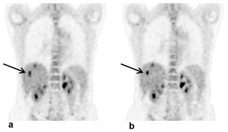 IBM肿瘤医生“沃森”被曝不好用,医疗AI前景堪忧?
