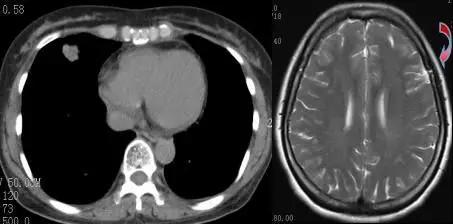 刚查出癌症头痛正常吗,头痛检查出癌症