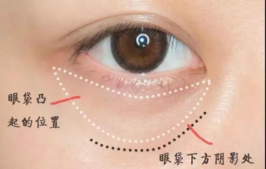 黑眼圈怎么遮眼袋,黑眼圈怎么遮瑕没有三文鱼色
