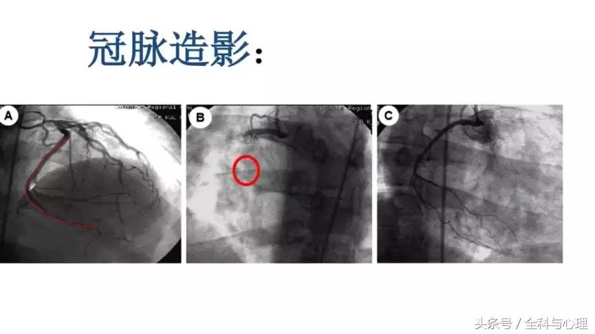一文读懂心血管疾病,左室心梗和右室心梗