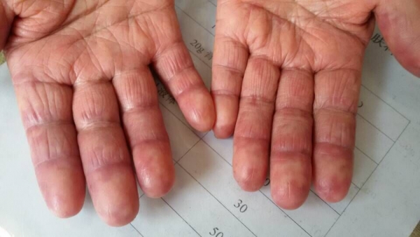 雷诺综合征的诊断与鉴别诊断,雷诺综合征怎么能诊断出来