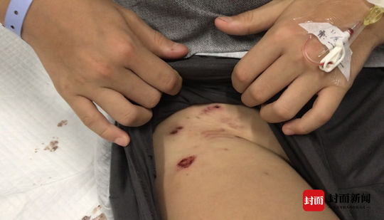 德牧被未牵绳主人暴打,在城市小孩被德牧咬伤怎么赔偿