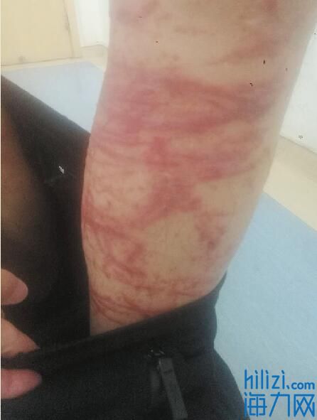 男子被蜇伤用艾蒿水洗致水疱和渗出