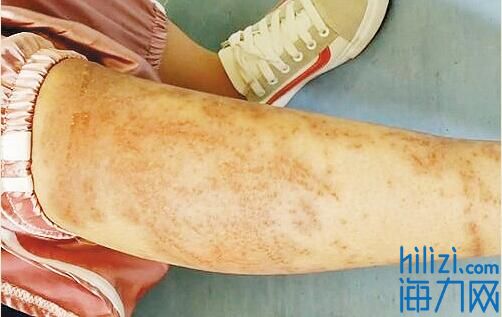 男子被蜇伤用艾蒿水洗致水疱和渗出