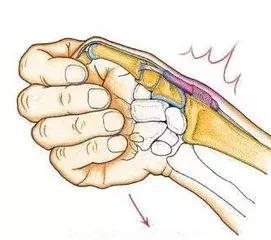电脑和手机催生腱鞘炎,送上熏蒸两方解困扰