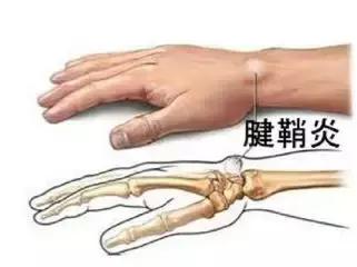 电脑和手机催生腱鞘炎,送上熏蒸两方解困扰