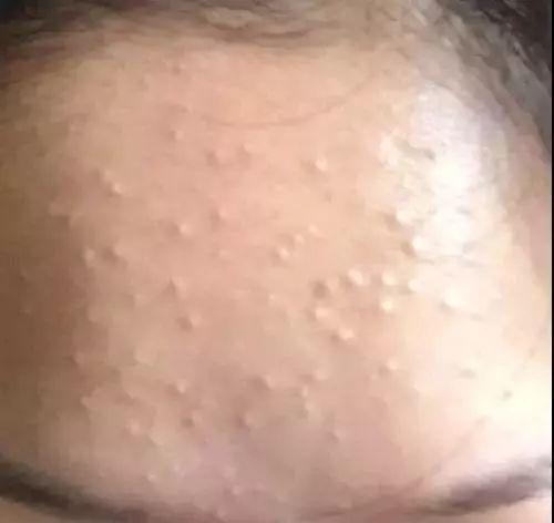 闭口消不下去,闭口挤不出来反而肿了多久能好