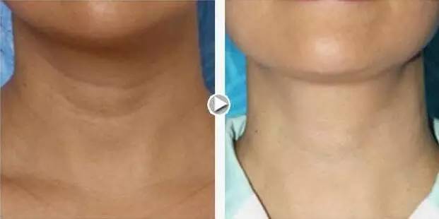 有人劝你打玻尿酸,打玻尿酸的一些常识问题