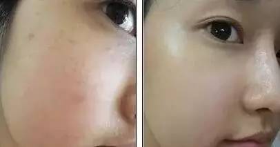 有人劝你打玻尿酸,打玻尿酸的一些常识问题