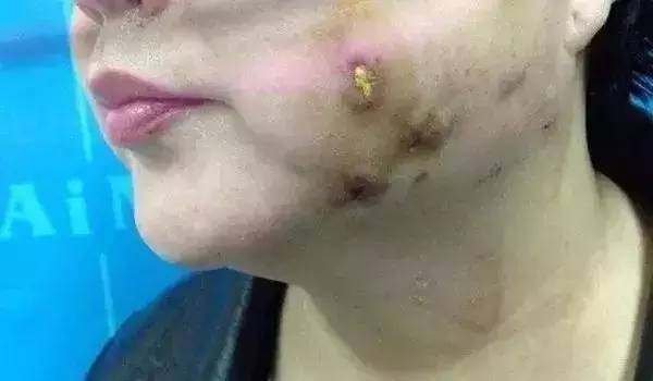 有人劝你打玻尿酸,打玻尿酸的一些常识问题