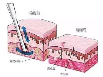 有人劝你打玻尿酸,打玻尿酸的一些常识问题