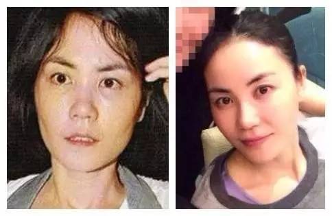 有人劝你打玻尿酸,打玻尿酸的一些常识问题